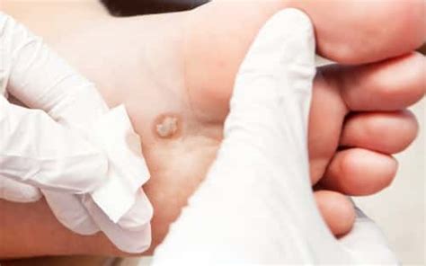 Blood blisters are not really a common condition but they also make discomfort and infection once occurring. Watery and Itchy Blisters on Hands and Feet | IYTmed.com