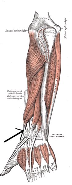 Congenital absence of the abductor pollicis brevis muscle should be kept in mind in patients with flattening of the thenar eminences. Musculus extensor pollicis brevis - Wikipedia
