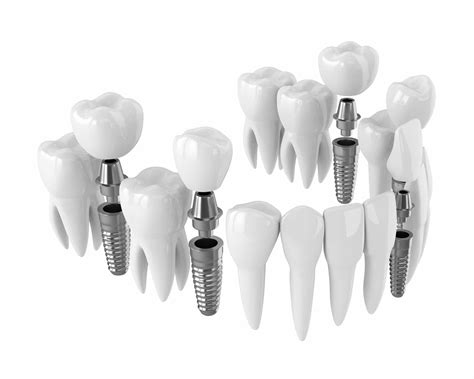 Woodland Hills Dentist Guides Implant Placement With Technology