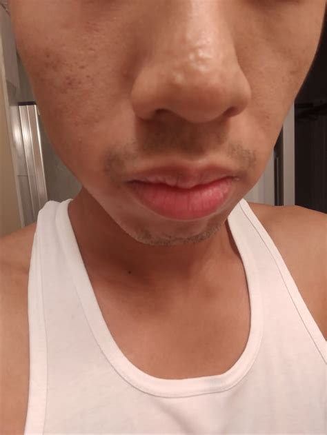 Skin Concerns How Do I Get Rid Of These Bumps On My Nose R