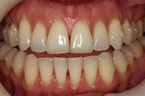 Black Triangle Treatment — Abadin Dental