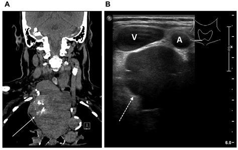 Figure 4 Imaging Soft Tissue Sarcomas Of The Head And Neck A