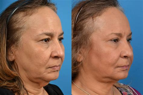 Patient 122406473 Laser Assisted Weekend Neck Lift Before And After