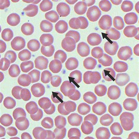 Platelet Morphology Blood Film Medschool