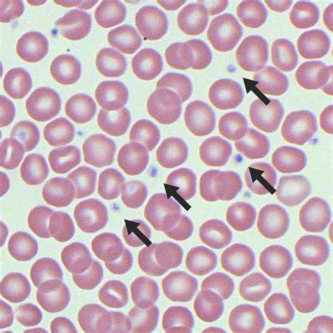 Sometimes only a blood test will show that something is wrong. Platelet Morphology | Blood Film - MedSchool