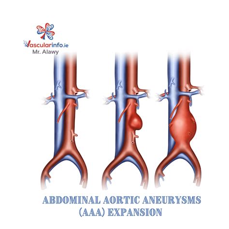 Abdominal Aortic Aneurysmaaa Vascular Info