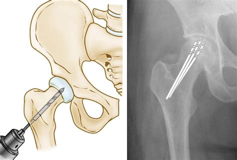 Surgical Technique Bone Graft For Avascular Necrosis Of The Hip My
