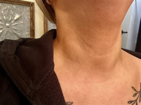 7 Weeks Of Swollen Lymph Nodesthyroid Rthyroidhealth