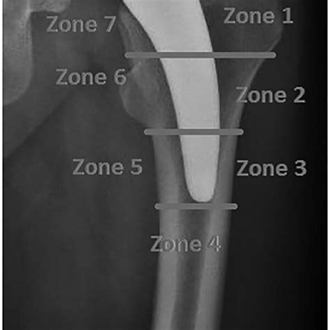 Gruen Zones In Short Hip Stems Download Scientific Diagram