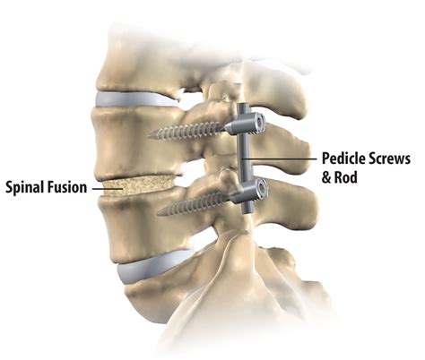 Spinal Fusion Washington D C Spine Surgeon