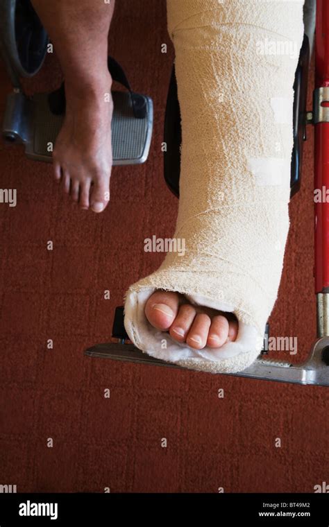 A Woman With Broken Ankle Bones Set In A Back Slab Plaster Cast Stock