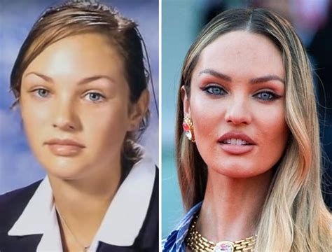 Candice Swanepoel Before And After Plastic Surgery Nose Boob Lips