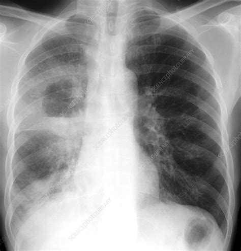 Lung Abscess X Ray Stock Image C0187138 Science Photo Library