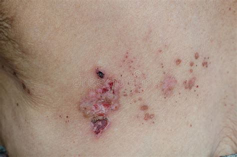 Zona image stock. Image du lésions, allergologiste, santé - 32807721