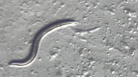 World First Discovery As A Worm Is Found Inside A Womans Brain In