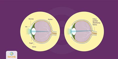 Kondisi ini juga disebut dengan istilah miopia. Lensa Mata Rabun Jauh - Bagis