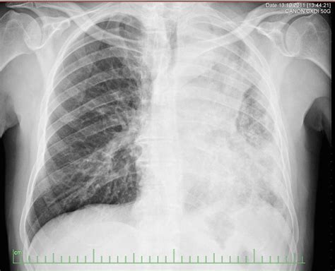 Lung Cancer Chest X Ray Wikidoc