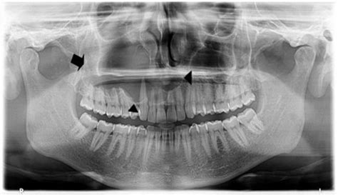 Preoperative Panoramic X Ray Showing Radiopacity Enlarged Right