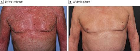 Successful Treatment Of Refractory Pityriasis Rubra Pilaris With