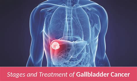 Stages And Treatment Of Gallbladder Cancer Cancer Healer Center