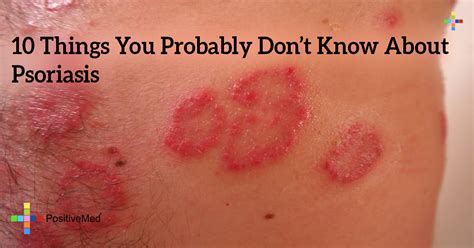 10 Things You Probably Dont Know About Psoriasis