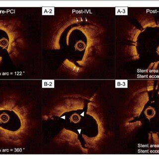 Representative Optical Coherence Tomography Oct Cross Sectional