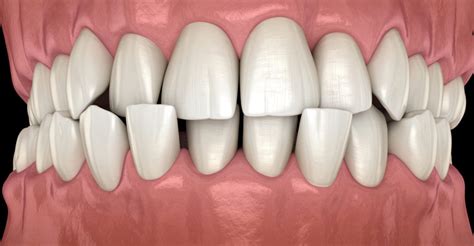 Side Effects Of Misaligned Teeth You May Not Know About Weston Dental