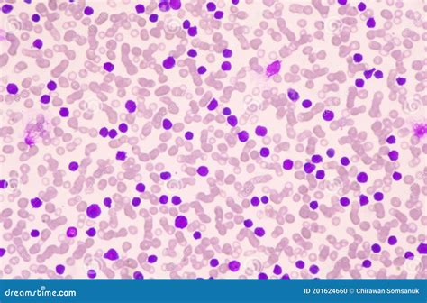 Moderate Blast Cell Of White Blood Cells In Blood Smear Stock Photo