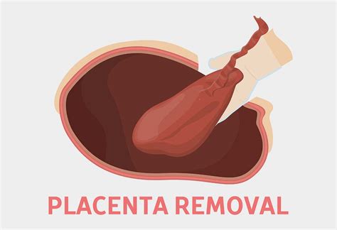 Eating Placenta After Birth Benefits And Risks