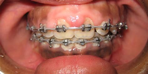 Swollen Gums Overgrown Gingiva During Orthodontic Treatment Causes