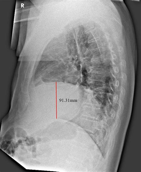Erect Right Lateral Cxr Of Case 1 Taken Two Days After Admission The