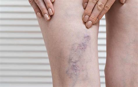 Varicose Veins In Pregnancy Mother Baby And Child