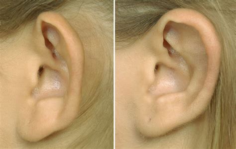 Plastic Surgery Case Study Otoplasty Surgery For Protruding Ears