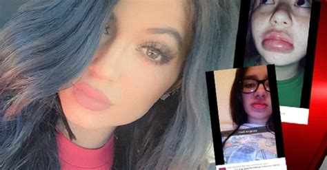 ‘kylie Jenner Challenge Leaving Teens With Disfigured Bruised Lips