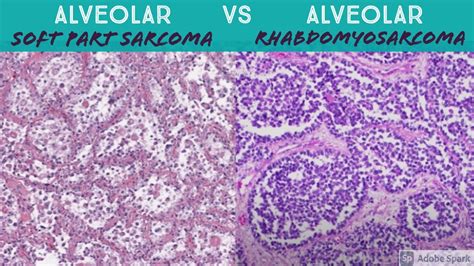 Alveolar Soft Part Sarcoma Vs Alveolar Rhabdomyosarcoma Youtube