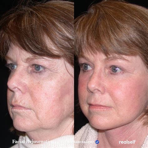 This Facial Rejuvenation Combo Included A Brow Lift Lower Facelift