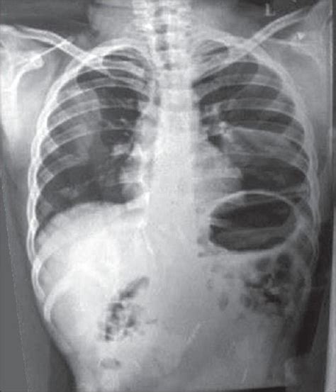 Chest X Ray Revealing Bilateral Cervical Ribs Open I