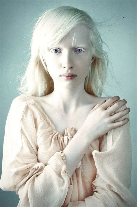 Albina Albinismo Albinismo Personas Albinas Y Rostros Humanos