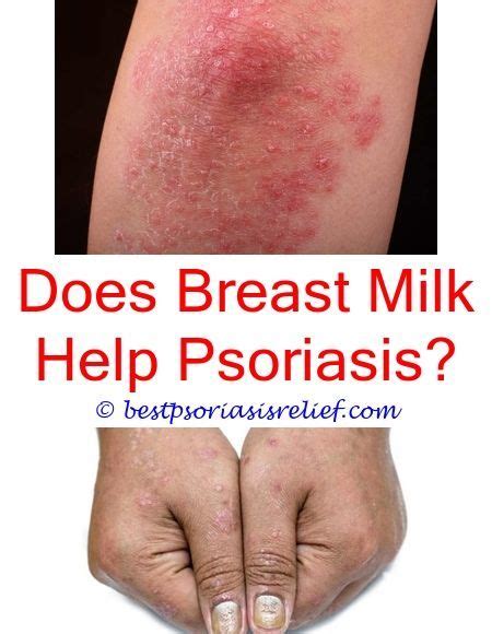 Whatisplaquepsoriasis Psoriasis Ayurvedic Home Remedies Psoriasis