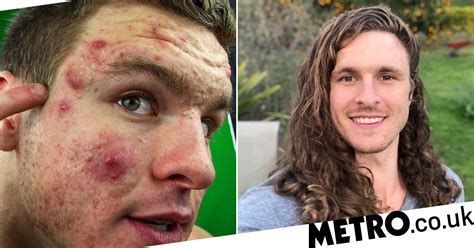 Bodybuilder Shares How He Cleared Painful Acne By Ditching Dairy