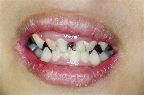 Broken Teeth Stock Photo Image Of Children Child Caucasian 80069392