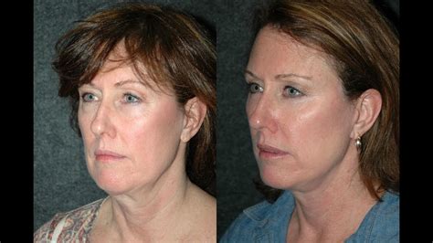 Best Facelift Surgeon New York Dr Andrew Jacono Reviews Youtube