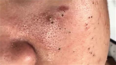 Giant Blackheads On The Face Part 2 Heat Exchanger Spare Parts