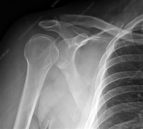 Dislocated Shoulder X Ray Stock Image C0393327 Science Photo