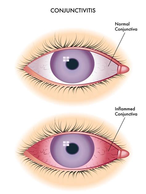 Conjunctivitis Nursing Management Rnpedia