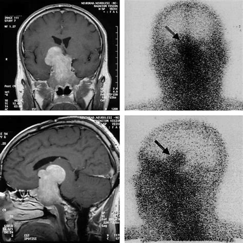 gadolinium enhanced magnetic resonance imaging of the pituitary a download scientific diagram