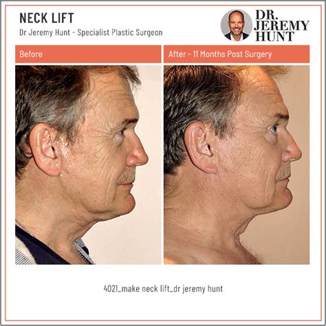 Male Neck Lift Facial Rejuvenation Dr Jeremy Hunt