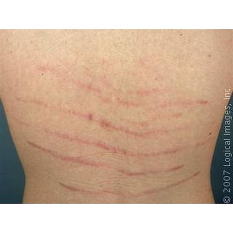 What Causes Stretch Marks On The Lower Back Healthfully