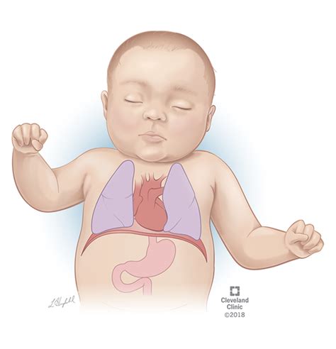 Cleveland Clinic Congenital Diaphragmatic Hernia On Behance