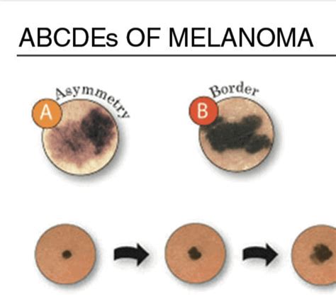 Know Your Moles Abcde Impact Melanoma